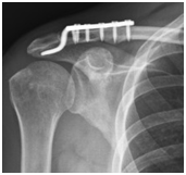 Shoulder Treatment of AC Joint Injury