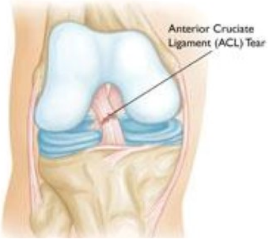 Knee Condition of MCL – Dr.Abhijit Ranaware