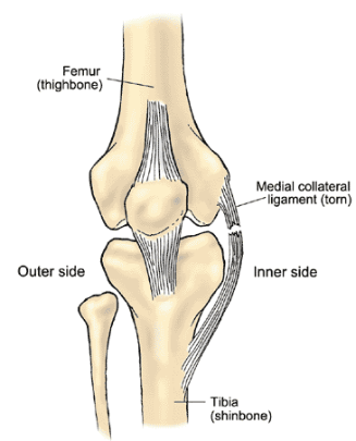 Medial Collateral Ligament Injuries (MCL Injuries) Of The Knee