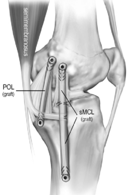 Complex Ligament Injuries: MCL/PCL Surgeons & Consultants, Yorkshire